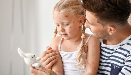 chickenpox in children