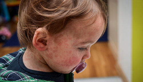 measles; measles symptoms; measles child; mmr vaccine;